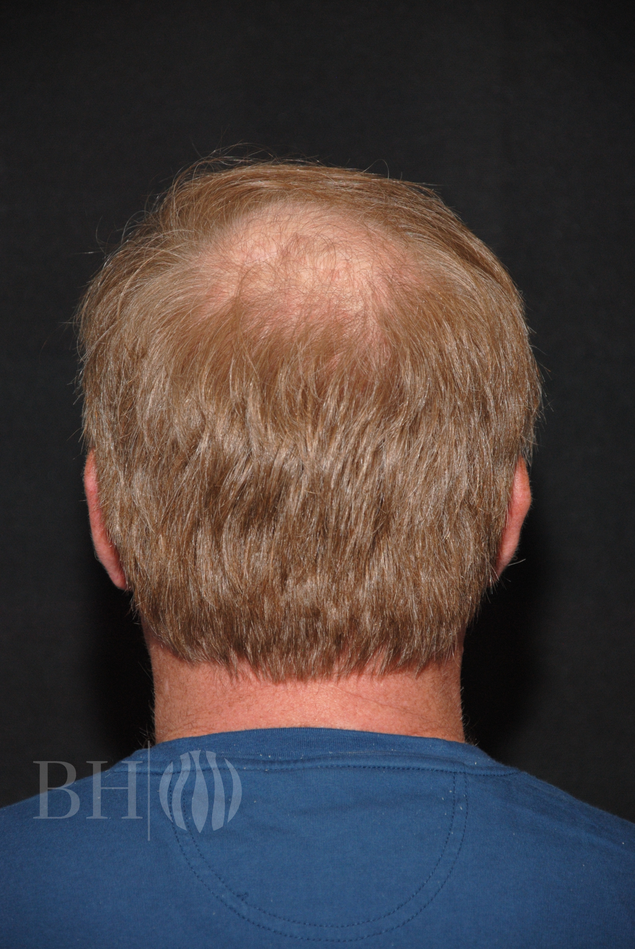 Neograft hair Before and After